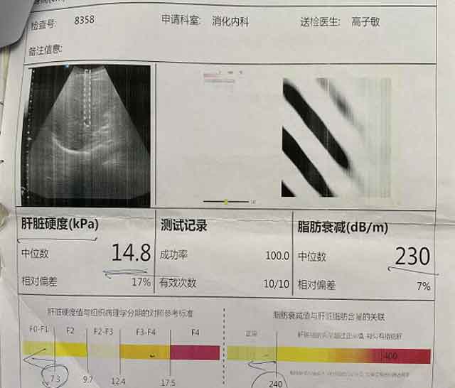 郑州肝病综合医院哪个看肝硬化比较好