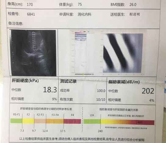 河南好的肝硬化医院?郑州什么医院治疗肝硬化好