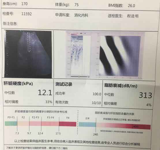 河南好的肝硬化医院?郑州什么医院治疗肝硬化好